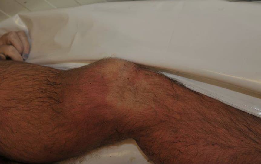 Taip atrodė velionio D. Kedžio perlaužta koja, kai jis, pasak lrytas.lt ir prokuratūros, parėjęs iš Ispanijos, kurioje slapstėsi, numirė Kauno marių pakrantėje uždusęs žolės lapu ir skrandžio turiniu su degtinės buteliu rankoje pilnu vandens.